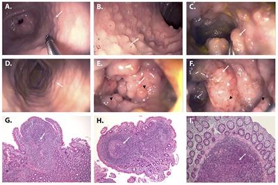 Case Report: Intestinal Nodular Lymphoid Hyperplasia as First Manifestation of Activated PI3Kδ Syndrome Due to a Novel PIK3CD Variant